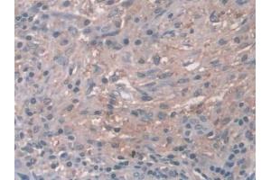 DAB staining on IHC-P; Samples: Human Breast cancer Tissue (Cathepsin Z anticorps  (AA 24-303))