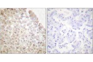 Immunohistochemistry analysis of paraffin-embedded human breast carcinoma tissue, using HDAC5 Antibody.