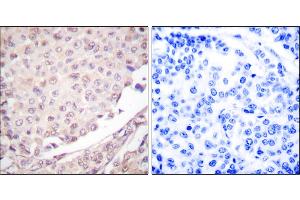Immunohistochemical analysis of paraffin-embedded human lung carcinoma tissue using Cullin 1 antibody.