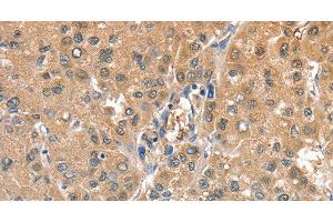Immunohistochemistry of paraffin-embedded Human liver cancer using CIAPIN1 Polyclonal Antibody at dilution of 1:60 (CIAPIN1 anticorps)