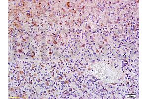 Formalin-fixed and paraffin embedded human glioma tissue labeled with Anti-WIG-1/PAG608 Polyclonal Antibody, Unconjugated (ABIN730108) at 1:200, followed by conjugation to the secondary antibody and DAB staining