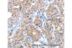Immunohistochemistry of Human lung cancer using AUP1 Polyclonal Antibody at dilution of 1:50 (Ancient Ubiquitous Protein 1 anticorps)