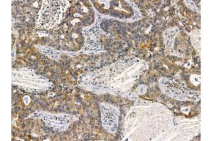 ABIN7095475 and ABIN7099532 at 1/100 staining human lung cancer by IHC-P. (TPD52 anticorps)