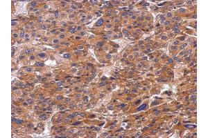 IHC-P Image Immunohistochemical analysis of paraffin-embedded human hepatoma, using SNX9, antibody at 1:500 dilution.