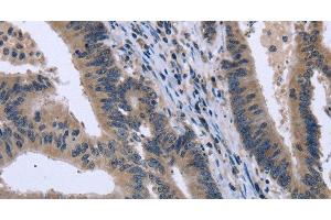 Immunohistochemistry of paraffin-embedded Human colon cancer tissue using KCNJ11 Polyclonal Antibody at dilution 1:40 (KCNJ11 anticorps)