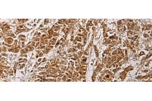 Immunohistochemistry of paraffin-embedded Human colorectal cancer tissue using HOXC5 Polyclonal Antibody at dilution of 1:55(x200) (Homeobox C5 anticorps)