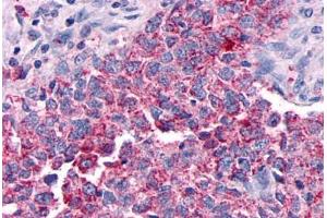 Anti-GPR30 antibody  ABIN1048792 IHC staining of human breast carcinoma. (GPER anticorps  (Extracellular Domain))