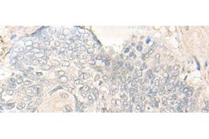 Immunohistochemistry of paraffin-embedded Human esophagus cancer tissue using DIMT1 Polyclonal Antibody at dilution of 1:30(x200) (DIMT1 anticorps)