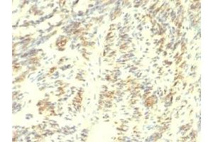 Formalin-fixed, paraffin-embedded human Leiomyosarcoma stained with Transglutaminase 2 antibody.