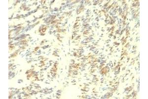 Formalin-fixed, paraffin-embedded human Leiomyosarcoma stained with Transglutaminase 2 antibody. (Transglutaminase 2 anticorps)