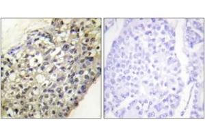 Immunohistochemistry analysis of paraffin-embedded human breast carcinoma tissue, using LATH Antibody. (LATH anticorps  (AA 71-120))