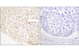 Immunohistochemistry analysis of paraffin-embedded human breast carcinoma tissue, using p18 INK Antibody. (P18 INK anticorps  (AA 111-160))