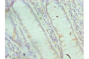 Immunohistochemistry of paraffin-embedded human colon cancer using ABIN7153695 at dilution of 1:100 (FABP6 anticorps  (AA 1-128))