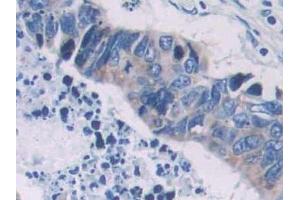 DAB staining on IHC-P; Samples: Human Colorectal cancer Tissue (PCOLCE anticorps  (AA 315-437))