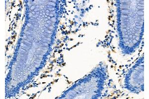 ABIN6257997 and ABIN6273474 at 1/100 staining Human colorectal cancer by IHC-P.