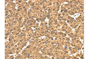 The image on the left is immunohistochemistry of paraffin-embedded Human liver cancer tissue using ABIN7130945(RRBP1 Antibody) at dilution 1/25, on the right is treated with fusion protein. (RRBP1 anticorps)