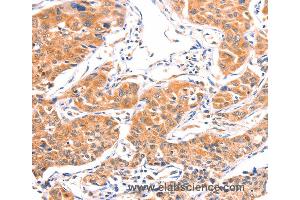 Immunohistochemistry of Human lung cancer using AMPD1 Polyclonal Antibody at dilution of 1:80 (AMPD1 anticorps)