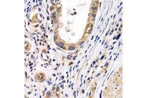 Immunohistochemistry of paraffin-embedded human gastric cancer using PTGIR antibody. (Prostacyclin Receptor anticorps)
