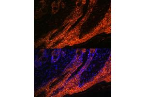 Immunofluorescence analysis of human skin cancer using IL1RA Rabbit mAb (ABIN7267971) at dilution of 1:100 (40x lens).