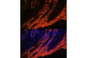 Immunofluorescence analysis of human skin cancer using IL1RA Rabbit mAb (ABIN7267971) at dilution of 1:100 (40x lens). (IL1RN anticorps)