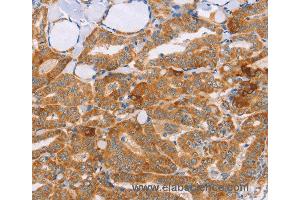 Immunohistochemistry of Human cervical cancer using CARD6 Polyclonal Antibody at dilution of 1:60 (CARD6 anticorps)
