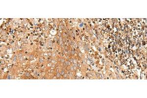 Immunohistochemistry of paraffin-embedded Human cervical cancer tissue using BAG3 Polyclonal Antibody at dilution of 1:35(x200) (BAG3 anticorps)