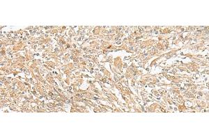 Immunohistochemistry of paraffin-embedded Human liver cancer tissue using GIPC1 Polyclonal Antibody at dilution of 1:50(x200) (GIPC1 anticorps)