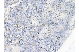 ABIN6255773 and ABIN6267263 at 1/100 staining human melanoma by IHC-P.