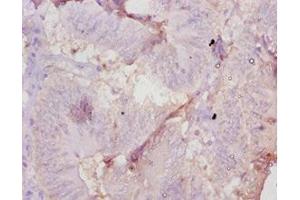 Immunohistochemistry of paraffin-embedded human colon cancer using ABIN7177698 at dilution of 1:10 (AMH anticorps  (AA 450-552))