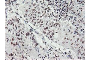 Immunohistochemical staining of paraffin-embedded Carcinoma of Human lung tissue using anti-MLF2 mouse monoclonal antibody. (MLF2 anticorps)