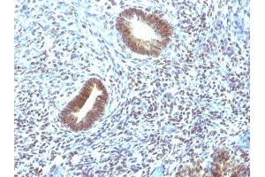 Formalin-fixed, paraffin-embedded human Uterine Carcinoma stained with MAP3K1 Mouse Monoclonal Antibody (2F6).
