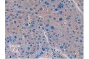 IHC-P analysis of Human Liver Cancer Tissue, with DAB staining. (IL-15 anticorps  (AA 50-162))