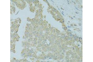 Immunohistochemistry of paraffin-embedded Human colon carcinoma using MTFP1 Polyclonal Antibody at dilution of 1:100 (40x lens). (Mtfp1 anticorps)