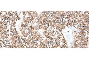 Immunohistochemistry of paraffin-embedded Human gastric cancer tissue using RNF111 Polyclonal Antibody at dilution of 1:50(x200)