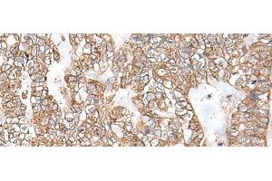 Immunohistochemistry of paraffin-embedded Human gastric cancer tissue using RNF111 Polyclonal Antibody at dilution of 1:50(x200) (RNF111 anticorps)