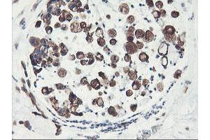 Immunohistochemical staining of paraffin-embedded Adenocarcinoma of Human colon tissue using anti-PFKP mouse monoclonal antibody. (PFKP anticorps)