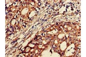 Immunohistochemistry of paraffin-embedded human gastric cancer using ABIN7145535 at dilution of 1:100 (BACE2 anticorps  (AA 84-157))