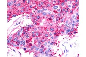 Anti-TPRA1 / GPR175 antibody IHC of human Breast, Carcinoma. (GPR175 anticorps  (Cytoplasmic Domain))