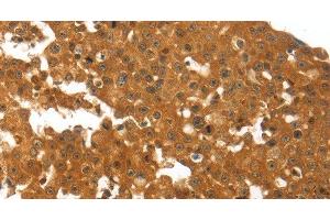 Immunohistochemistry of paraffin-embedded Human breast cancer using TNFRSF11B Polyclonal Antibody at dilution of 1:30 (Osteoprotegerin anticorps)