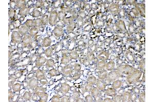 IHC analysis of GST3 / GST pi using anti-GST3 / GST pi antibody . (GSTP1 anticorps  (AA 2-210))