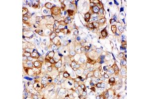 Anti- HSP27 antibody, IHC(P) IHC(P): Human Mammary Cancer Tissue (HSP27 anticorps  (AA 1-205))
