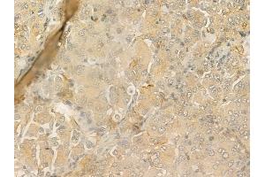 ABIN6258613 and ABIN6274911 at 1/100 staining human lung adenocarcinoma by IHC-P.