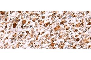 Immunohistochemistry of paraffin-embedded Human gastric cancer tissue using INO80 Polyclonal Antibody at dilution of 1:85(x200) (INO80 anticorps)