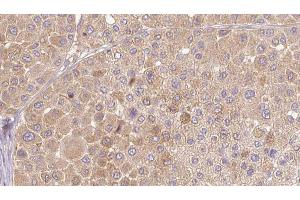 ABIN6272654 at 1/100 staining Human Melanoma tissue by IHC-P. (PSG3 anticorps)