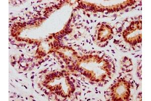 IHC image of ABIN7127704 diluted at 1:100 and staining in paraffin-embedded human breast cancer performed on a Leica BondTM system.