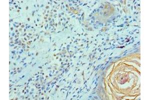 Immunohistochemistry of paraffin-embedded human breast cancer using ABIN7152098 at dilution of 1:100 (Elf4 anticorps  (AA 1-200))