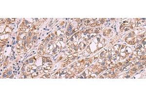 Immunohistochemistry of paraffin-embedded Human liver cancer tissue using JAZF1 Polyclonal Antibody at dilution of 1:35(x200) (JAZF1 anticorps)