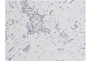 ABIN6267524 at 1/200 staining Human bladder cancer tissue sections by IHC-P.