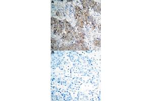 Immunohistochemical staining of human breast cancer tissue by IGF1R (phospho Y1161) polyclonal antibody  without blocking peptide (A) or preincubated with blocking peptide (B) under 1:50-1:100 dilution. (IGF1R anticorps  (pTyr1161))