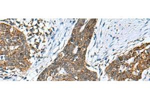 Immunohistochemistry of paraffin-embedded Human esophagus cancer tissue using PREPL Polyclonal Antibody at dilution of 1:55(x200) (PREPL anticorps)
